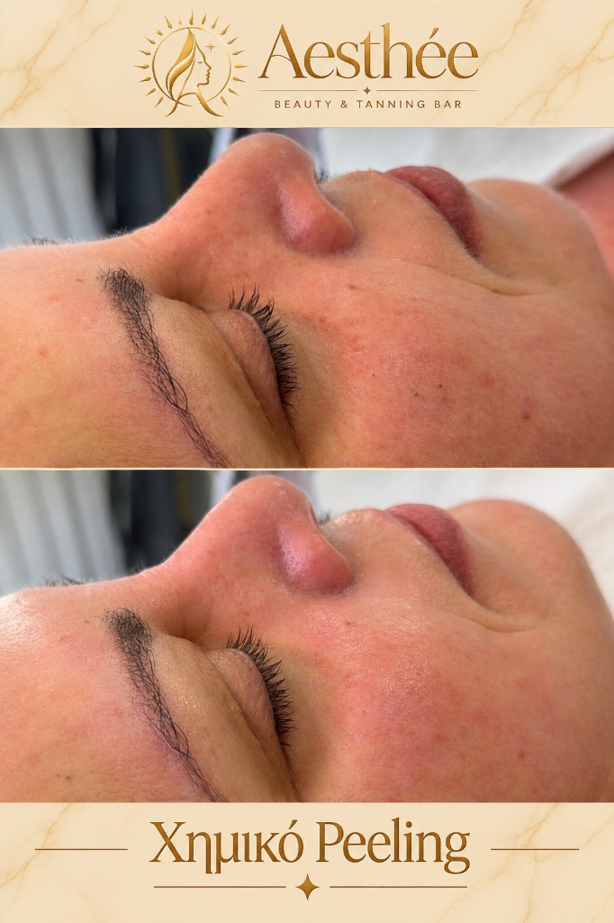 Πριν και μετά — χημικό peeling