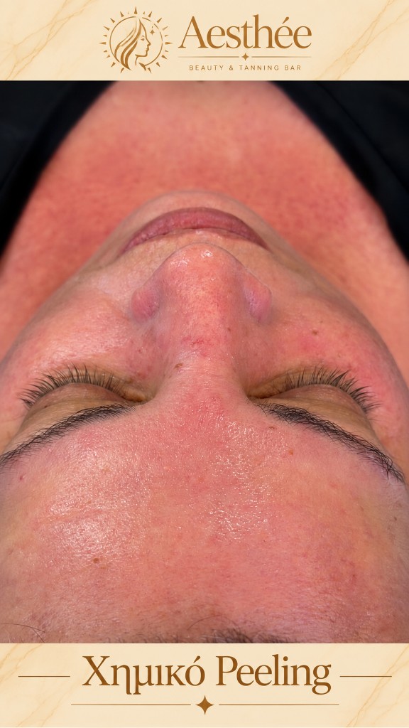 Πριν και μετά — χημικό peeling εφαρμογή