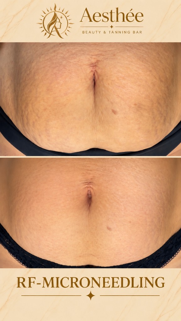 Πριν και μετά — RF Microneedling ραγάδες κοιλιάς