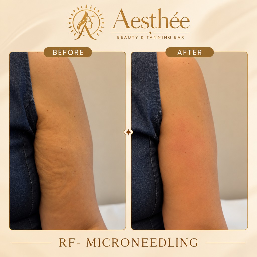 Πριν και μετά — RF Microneedling χέρι