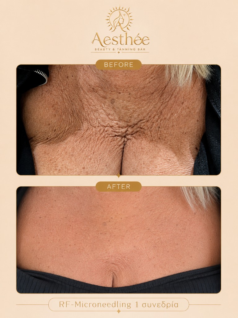 Πριν και μετά — RF Microneedling ντεκολτέ