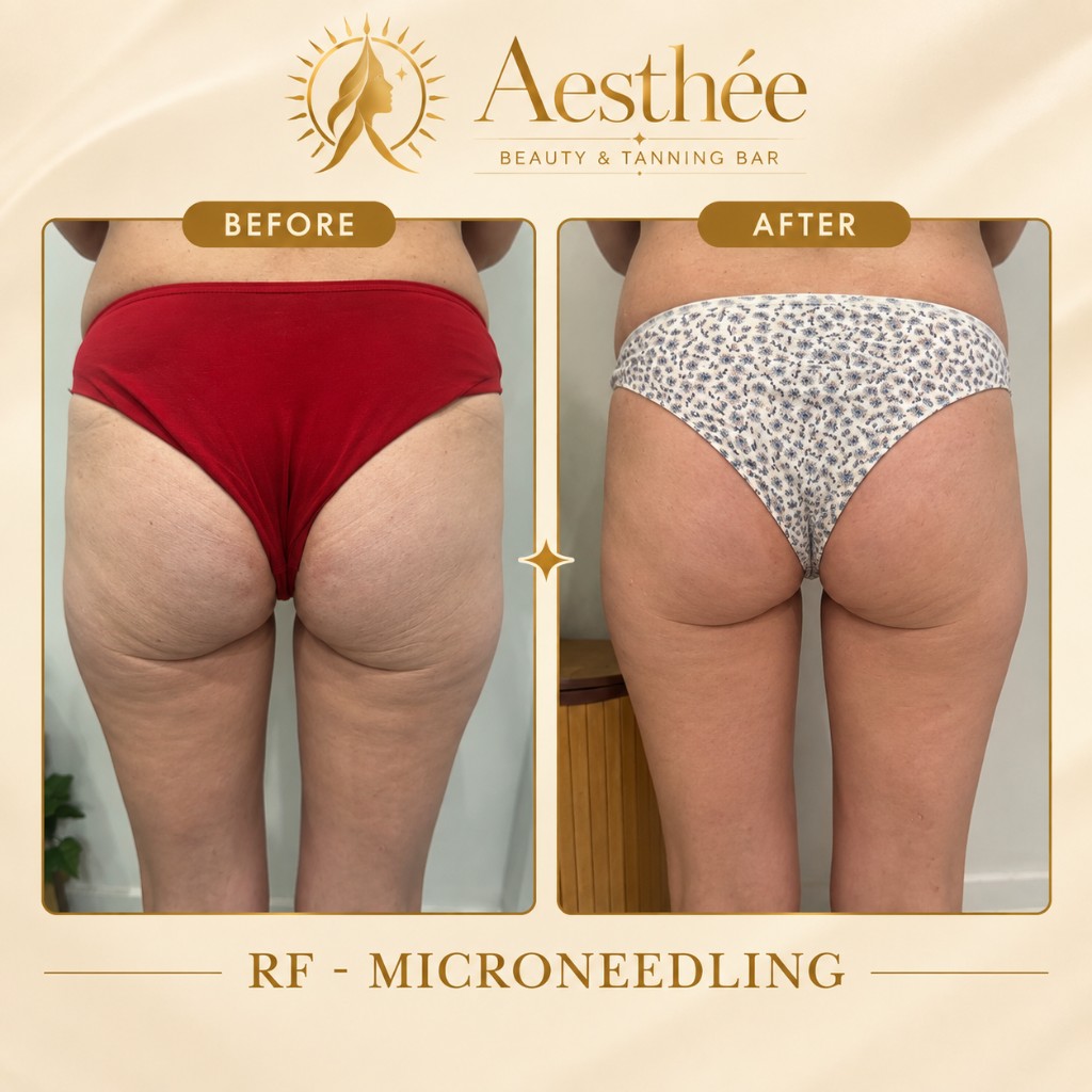 Πριν και μετά — RF Microneedling γλουτοί