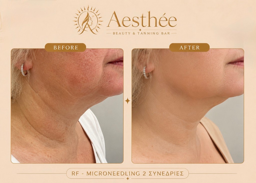 Πριν και μετά — RF Microneedling προσώπου