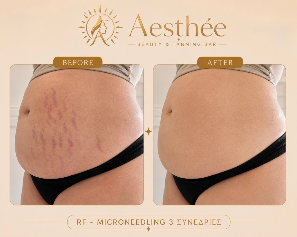 Πριν και μετά — RF Microneedling ραγάδες