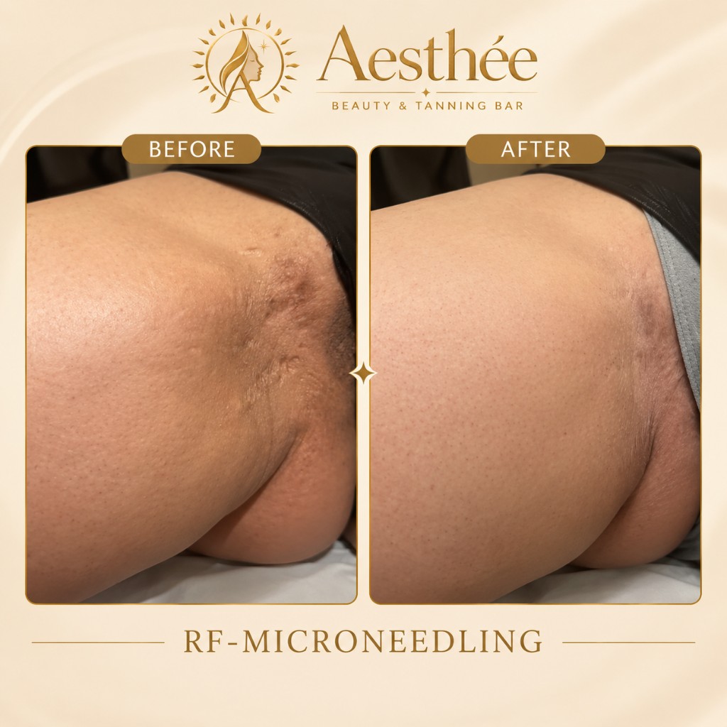 Πριν και μετά — RF Microneedling μηροί
